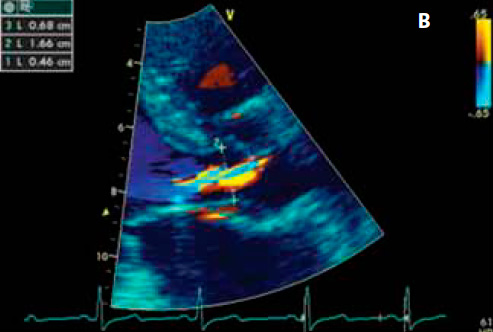 Hipertensión arterial maligna e hiperaldosteronismo hiperreninémico