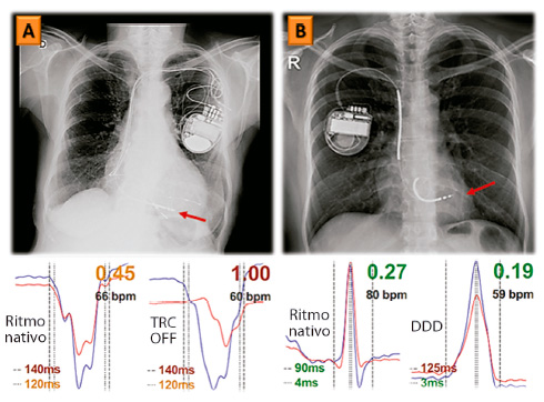 Estimulación del ventrículo derecho como causante y agravante de disincronía ventricular