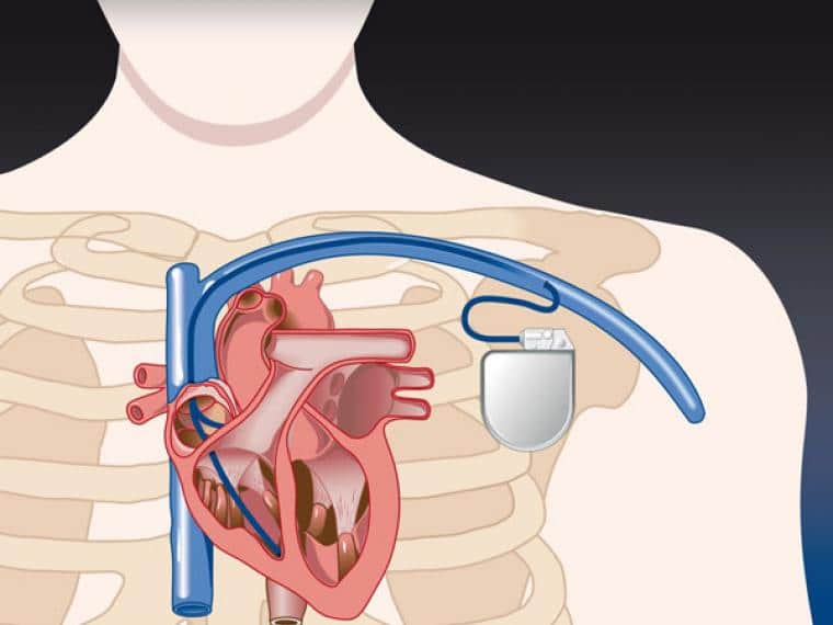 El concepto actual de las guías para implante de marcapasos cardiacos